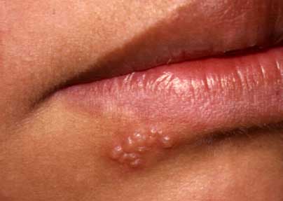 herpes-labial